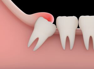 Animation about a  bad tooth need to be removed behind the other teeth in the mouth